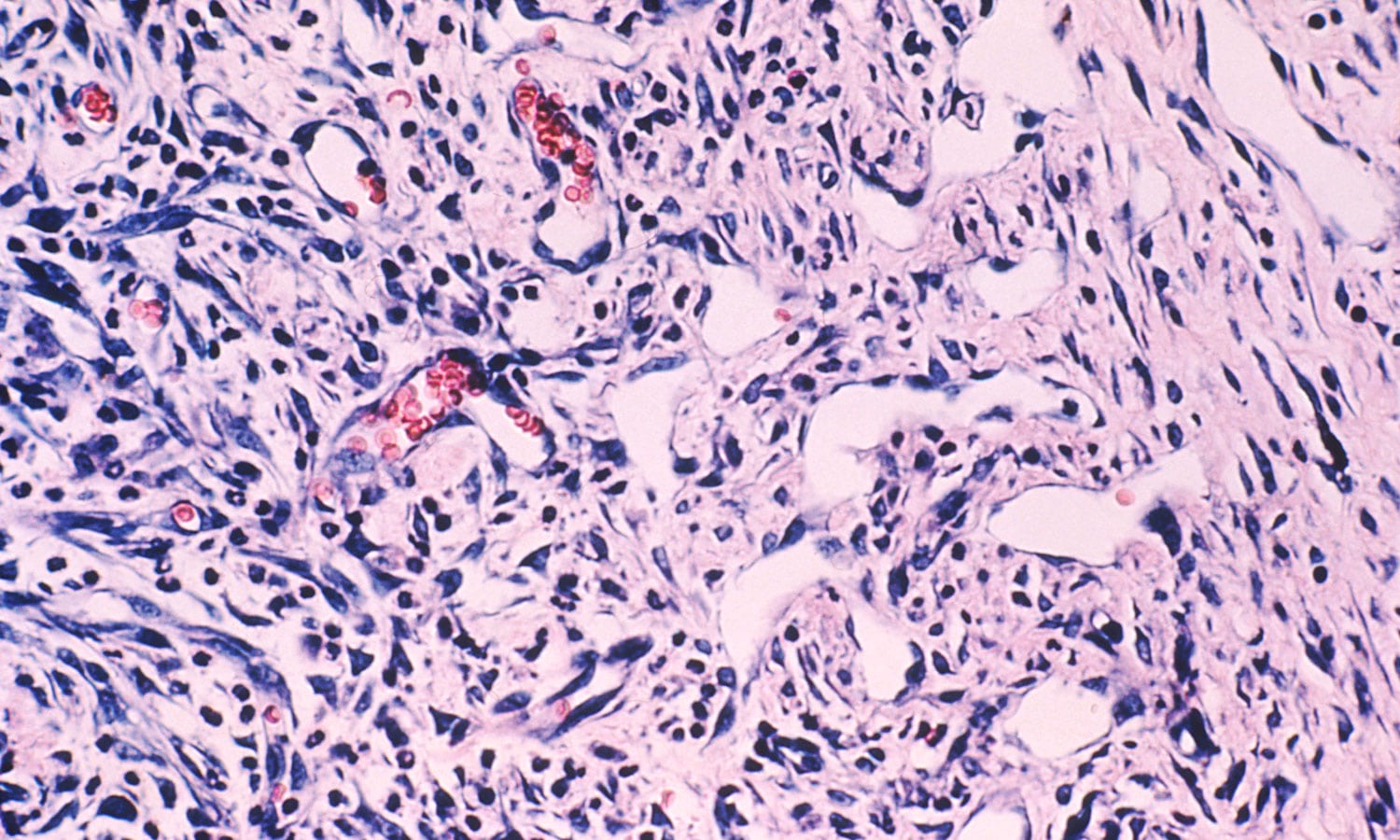 Kaposi Sarcoma Rash