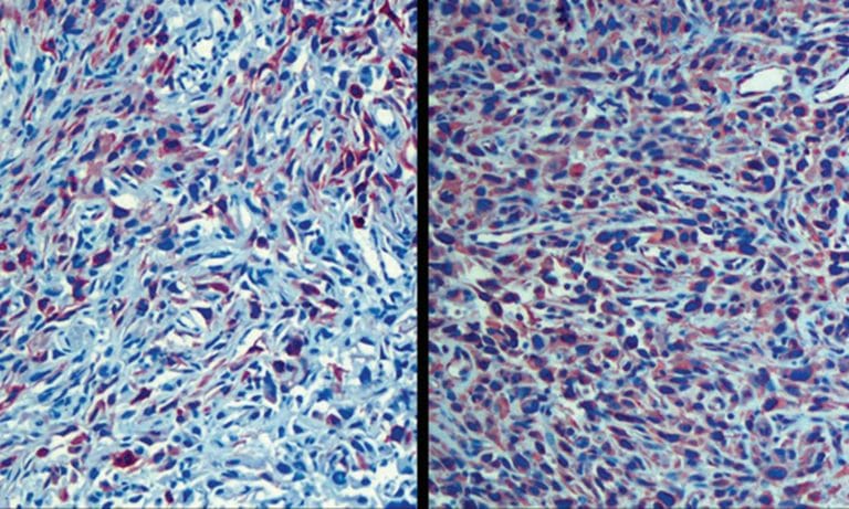 Information About Marijuana And Bladder Cancer