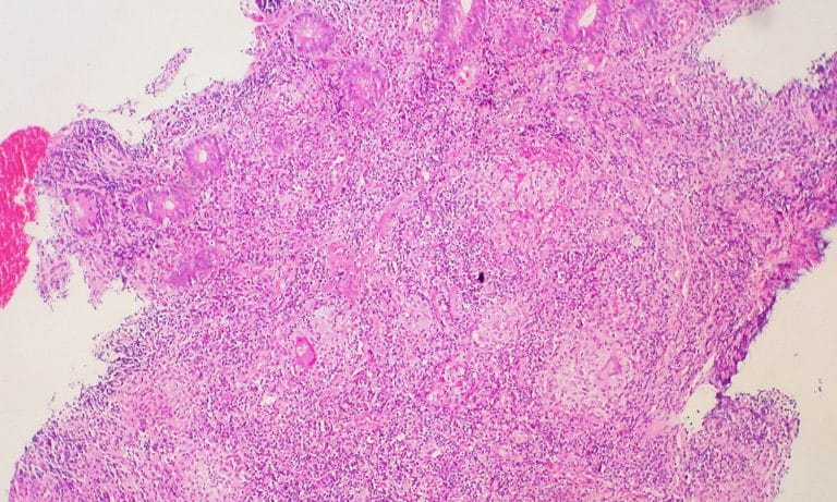 Can Medical Marijuana Help With My Crohn’s Disease?