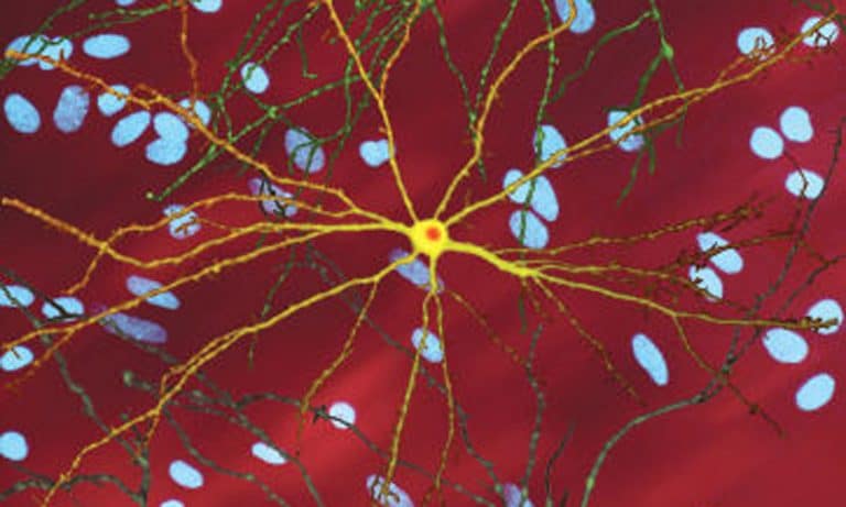 How Medical Marijuana Can Mitigate Symptoms Of Huntington’s Disease