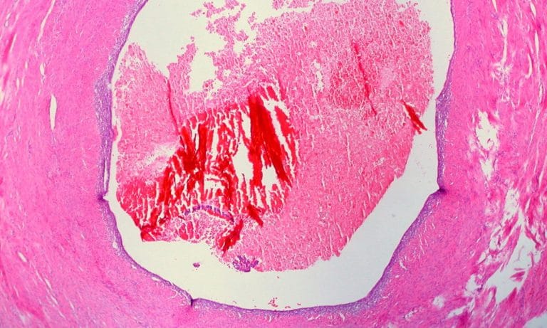 How Marijuana Can Help With The Pain From Endometriosis