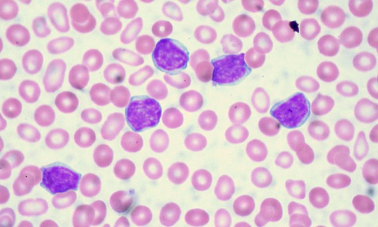 Here’s Why Marijuana Can Have A Huge Impact On Leukemia Patients