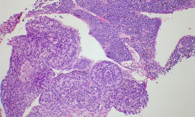 How Marijuana Can Interfere With And Disrupt Leukemia Cells