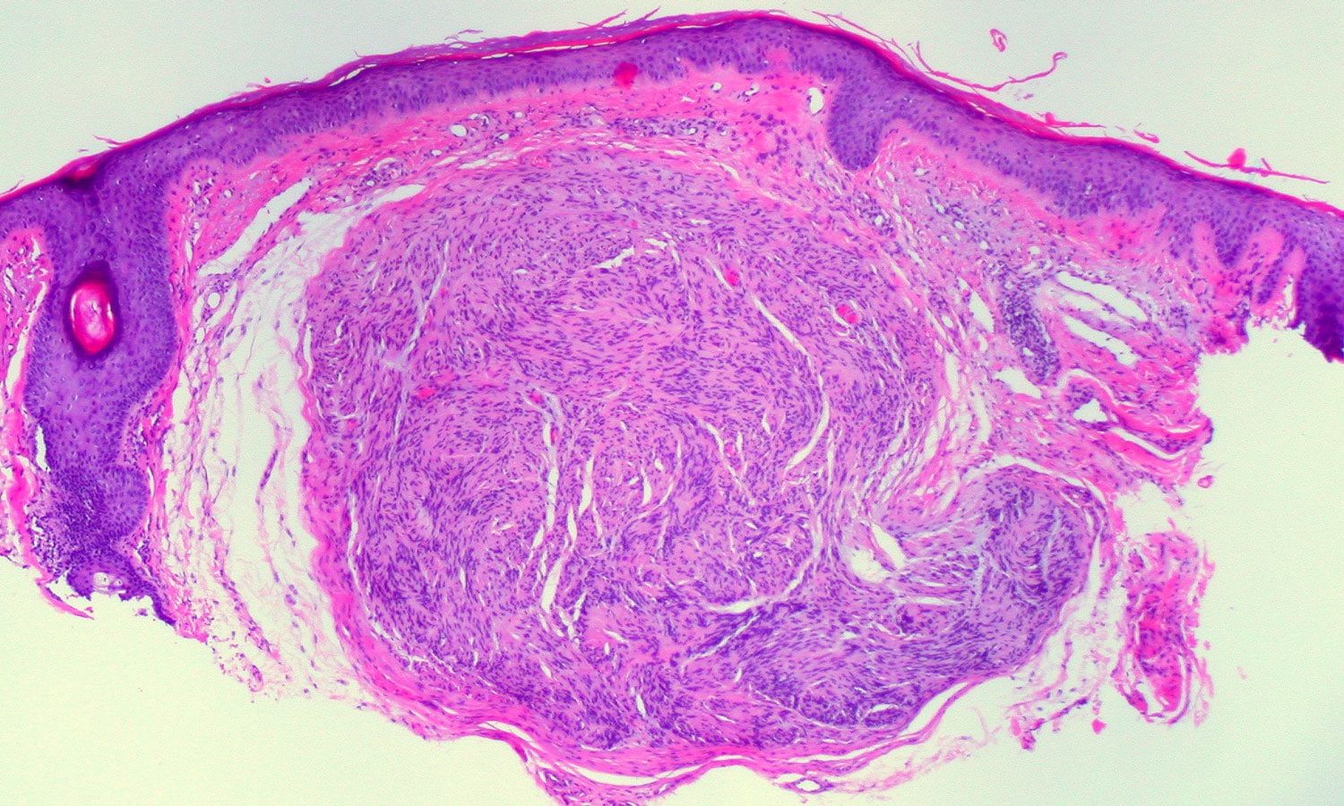 melanoma cancer cells