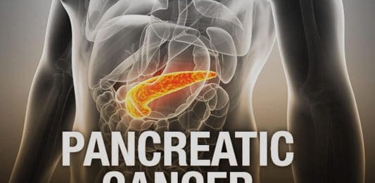 pancreatic cancer