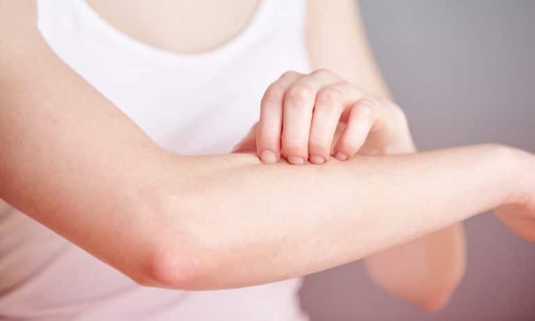 Let’s Talk About How Medical Marijuana Can Help With Eczema