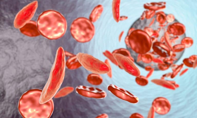 Medical Marijuana Can Help Sufferers Of Sickle Cell Anemia