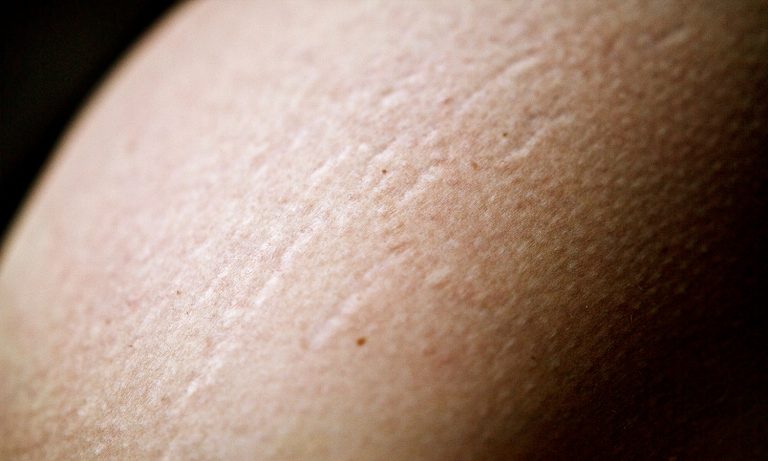 4 Tips To Treat And Prevent Stretch Marks