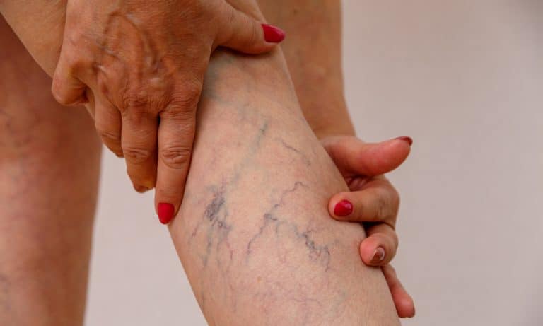 What To Know About CBD’s Effects On Varicose Veins