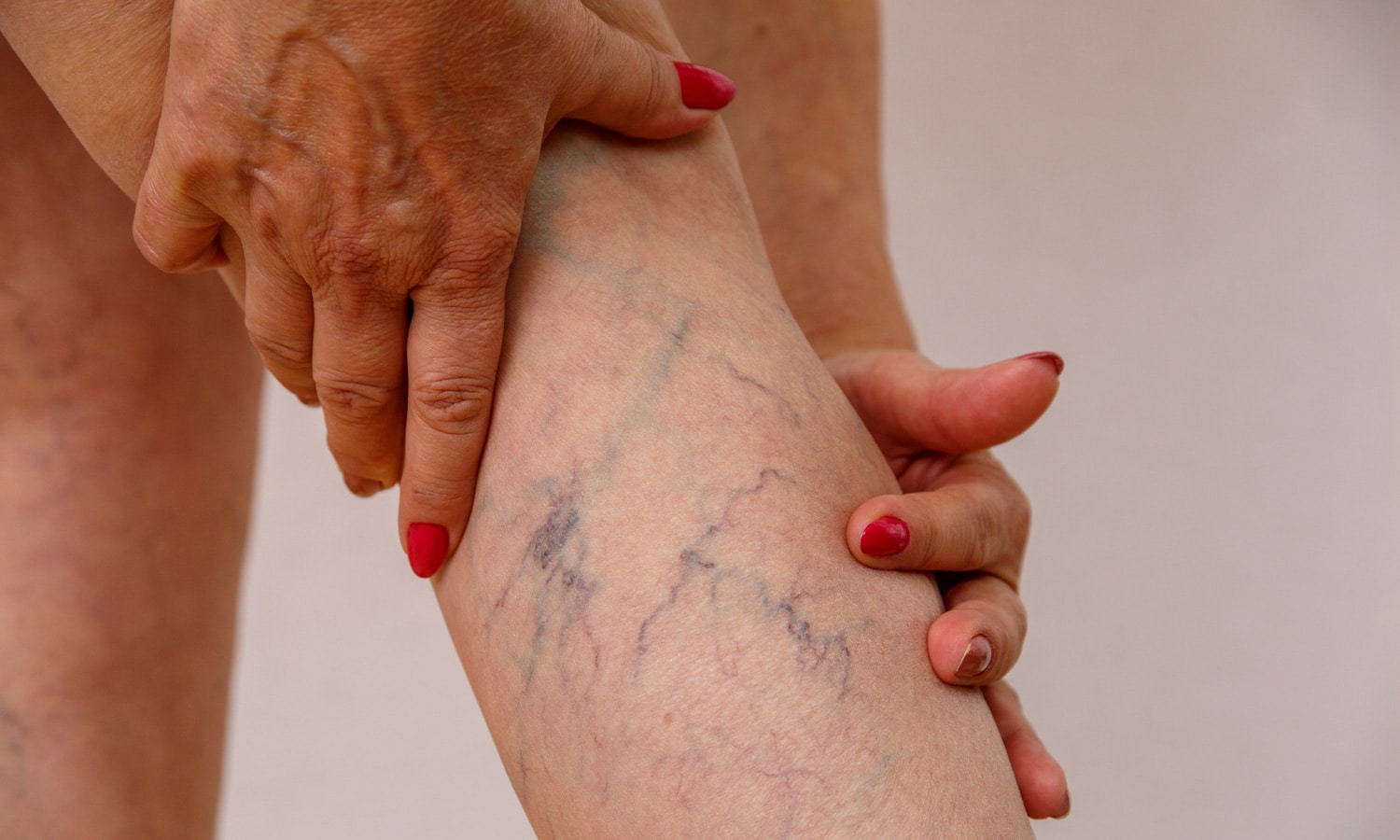 Here's What We Know About CBD's Effects On Varicose Veins