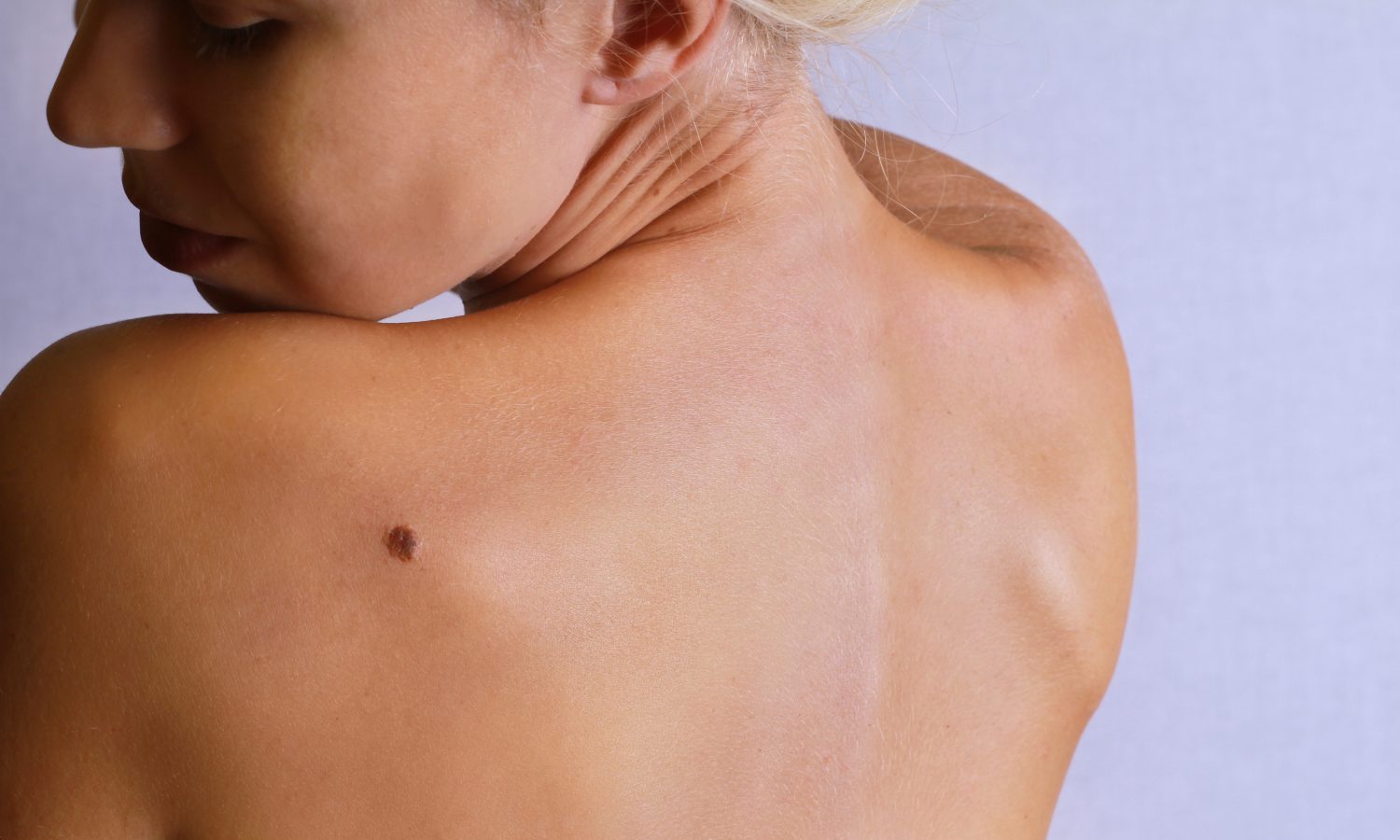 Top 10 Risk Factors Of Melanoma And How To Prevent It
