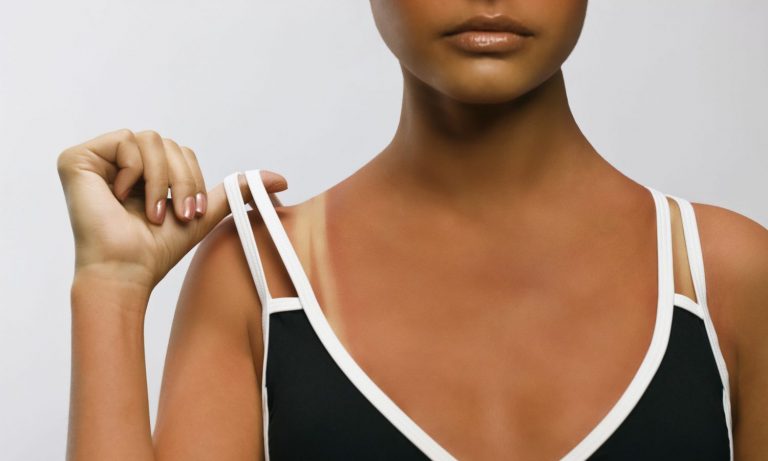 Does CBD Help With A Sunburn?