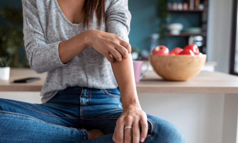 CBD Oil And Psoriasis Treatment