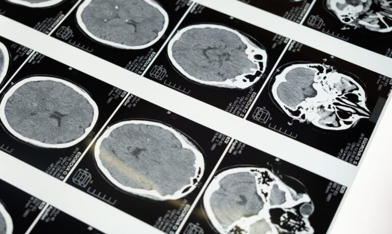 CBD And CBG Show Promising Results In Treating Glioblastoma Brain Tumors