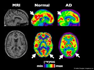 Cannabis and CBD May Help Patients With Alzheimer's and Dementia